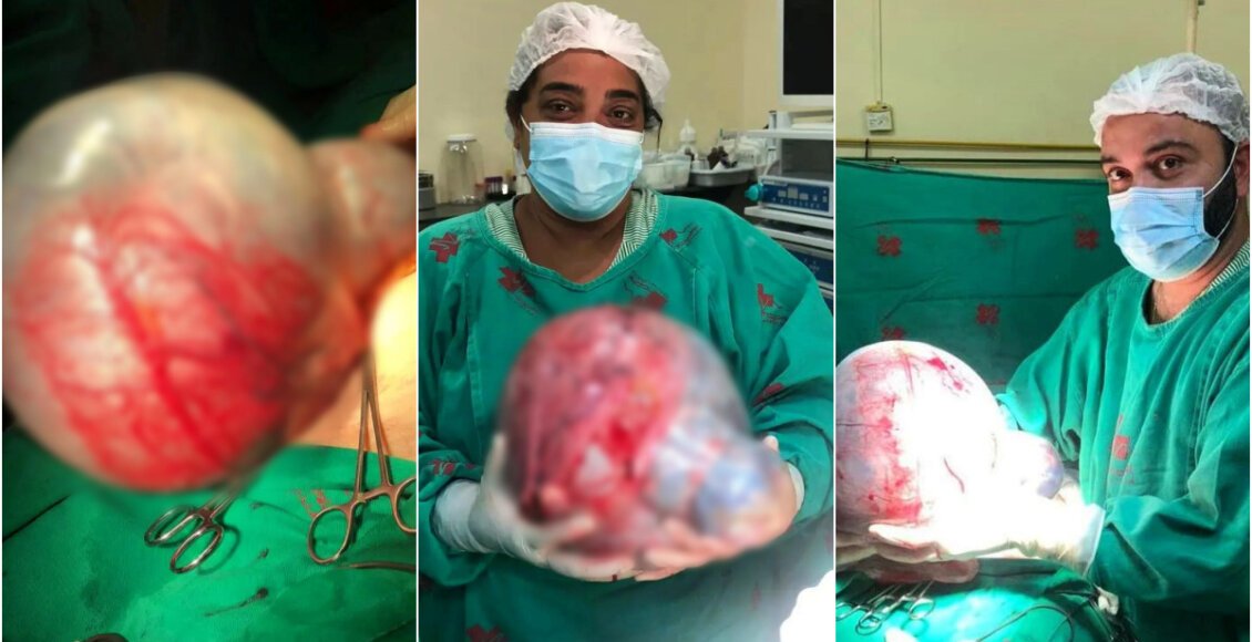 Médico mostra cisto gigante ovariano retirado de idosa em São Fidélis