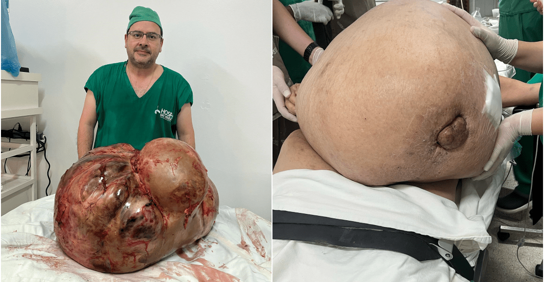 Tumor de 46 quilos é retirado de uma paciente em Itaperuna