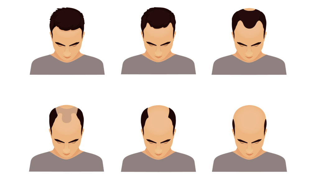 Cerca de 50% da população masculina sofre de calvície