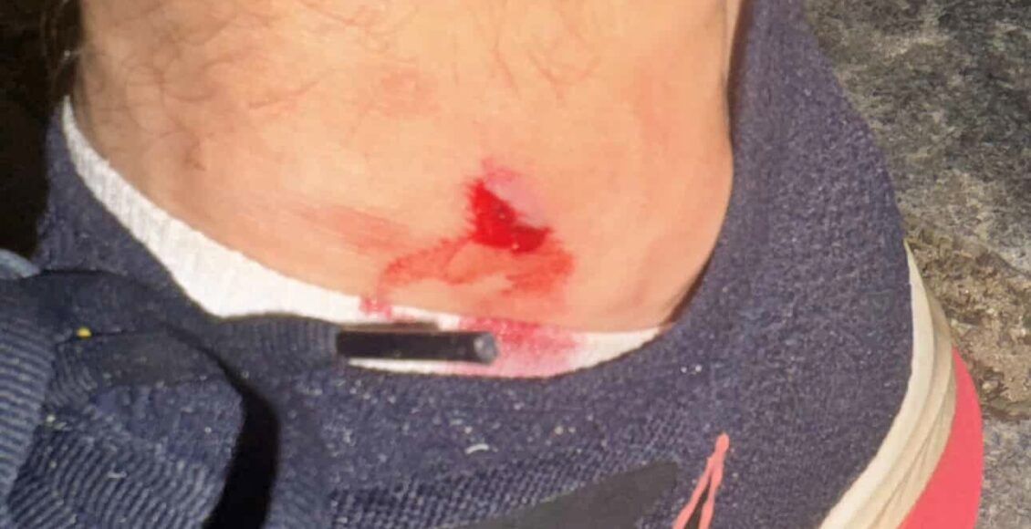 ferida pequena com sangue